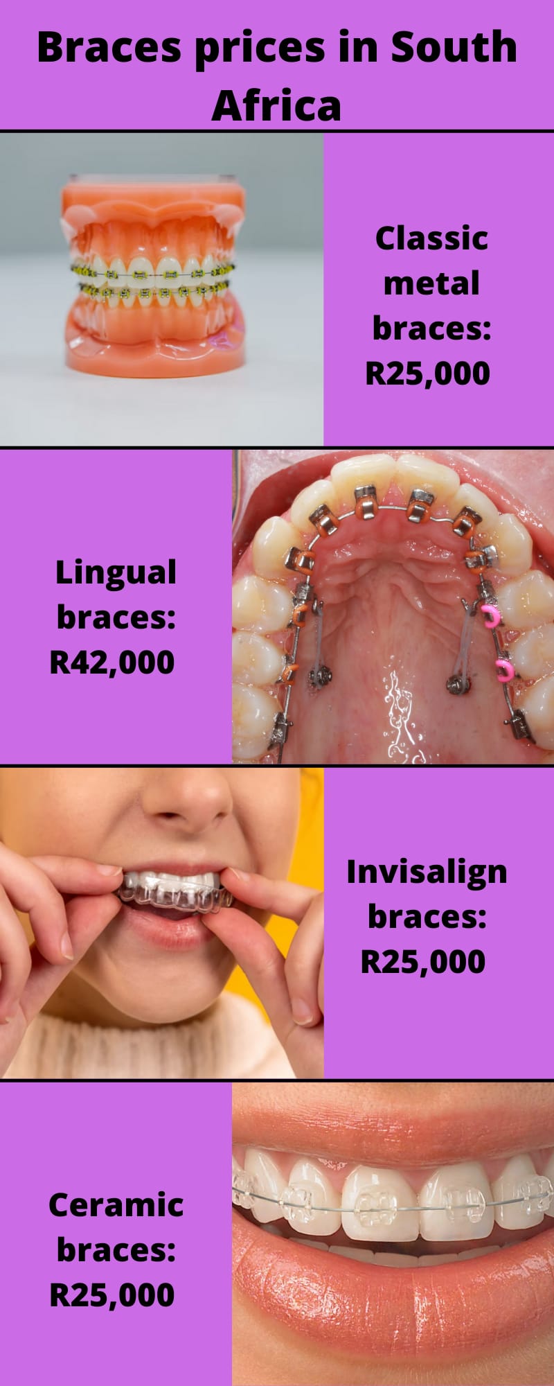 Price Of Braces For Teeth