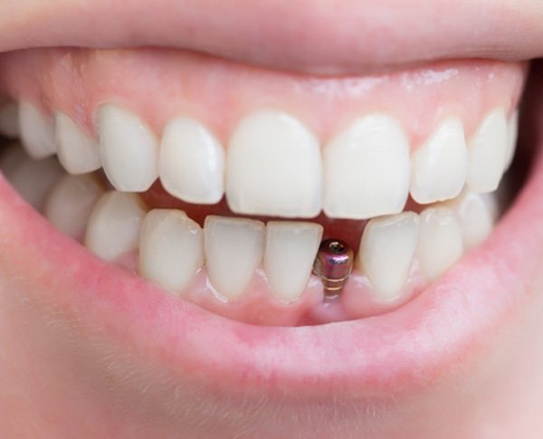Pull Tooth Near Me: Fast Relief Today