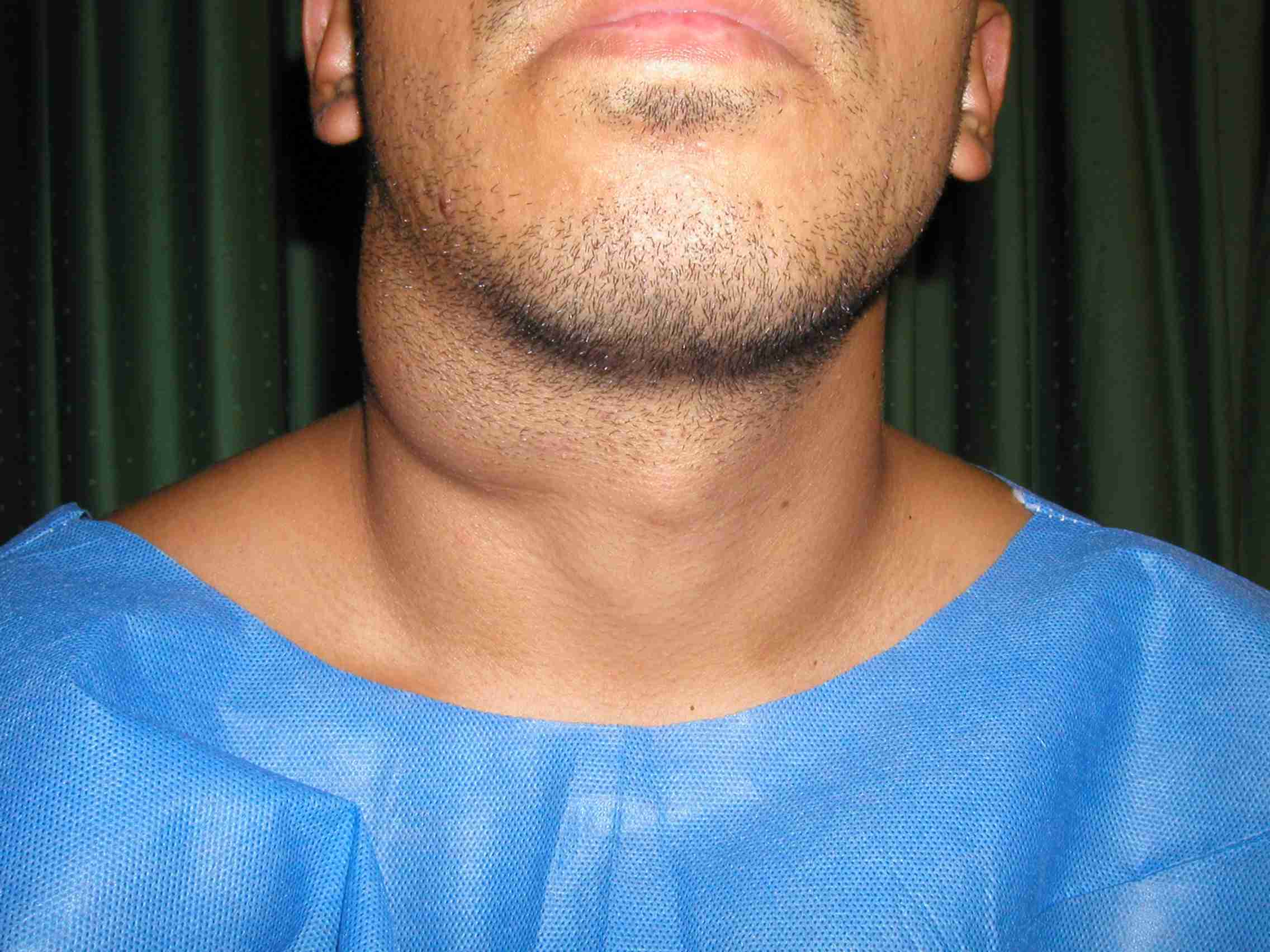 Quiste En El Cuello Sonografia: Solución Precisa Quiste En El Cuello Sonografia: Solución Precisa