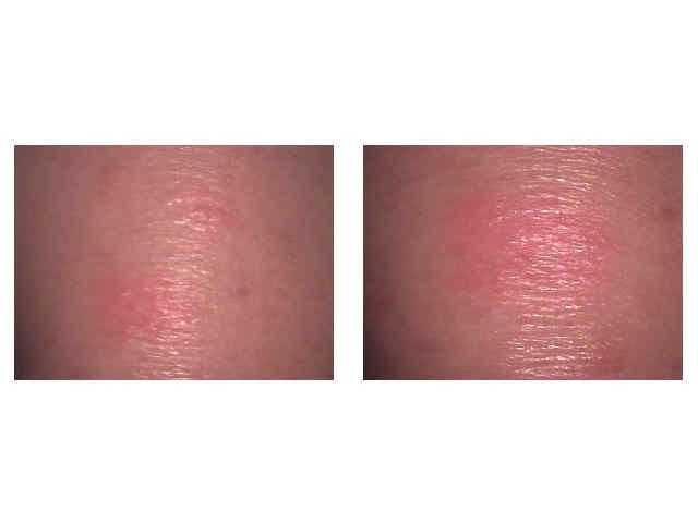 Reaction To Novocaine