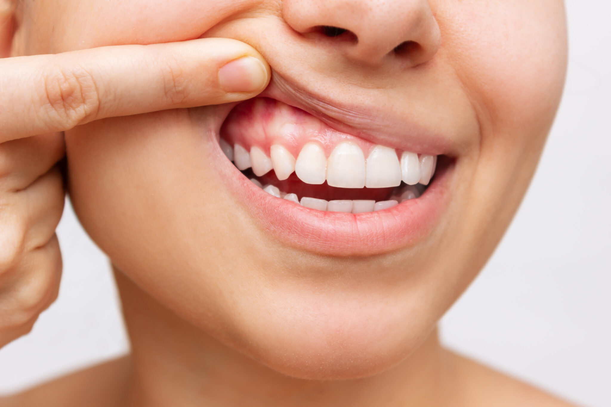 Remove Black Gums: Get Healthy Smile