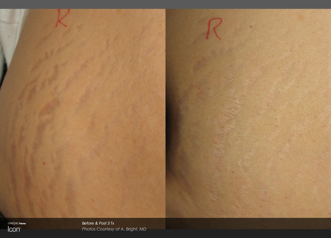 Remove Stretch Marks Laser: Fast Results Guaranteed