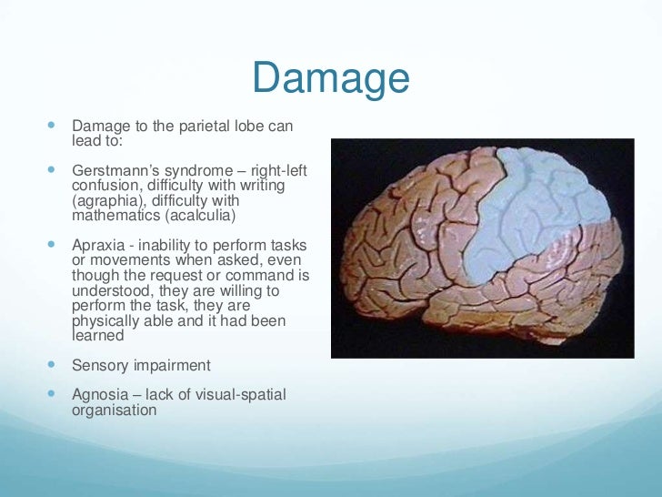 Right Parietal Cva