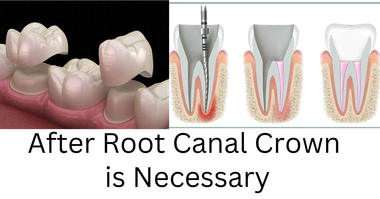 Root Canal No Crown