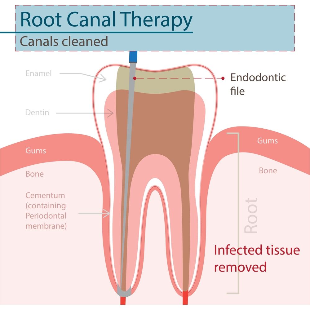 Root Canal Treatment: Avoid Crowns With This Solution