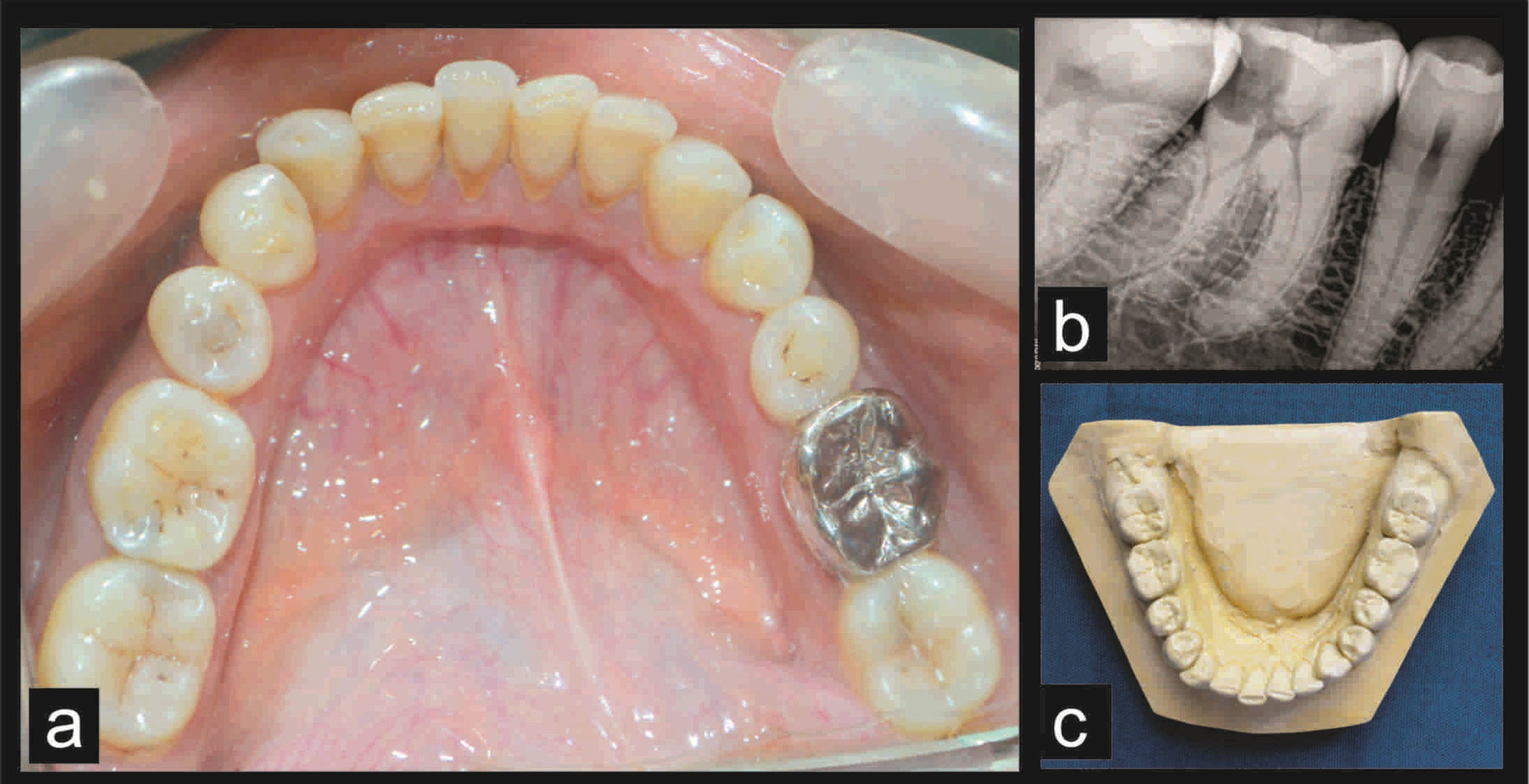 Rough Surface Teeth