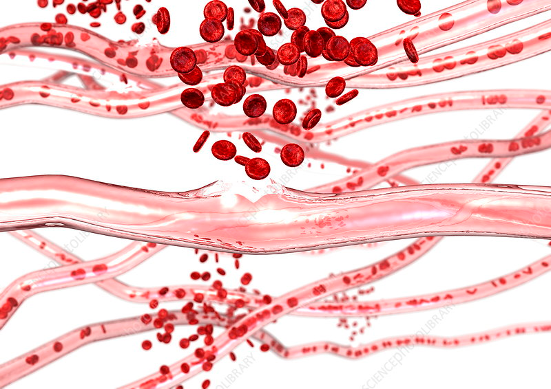 Ruptured Blood Vessel In Mouth
