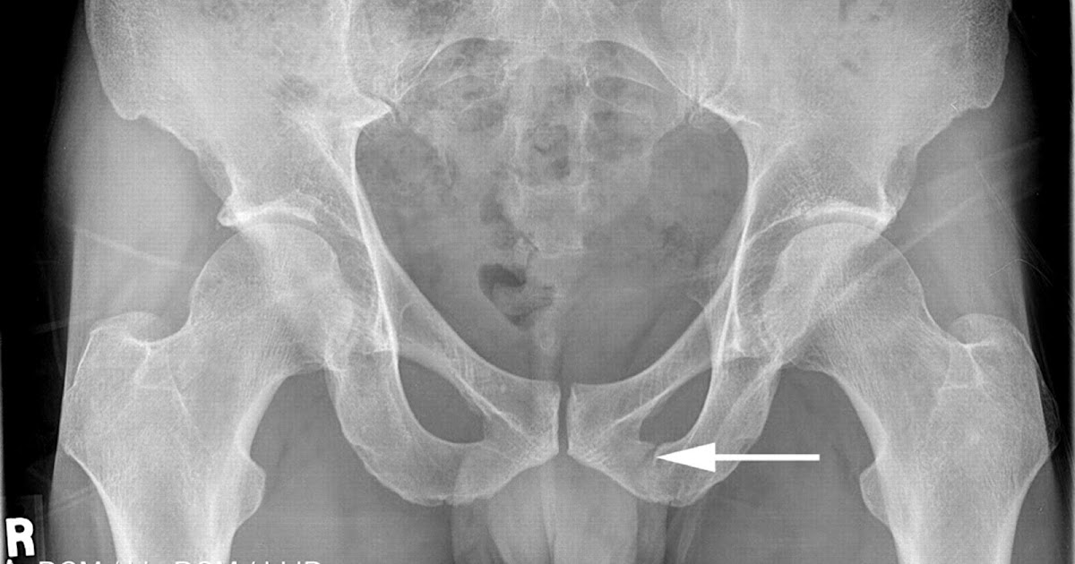 Sacrum Hairline Fracture