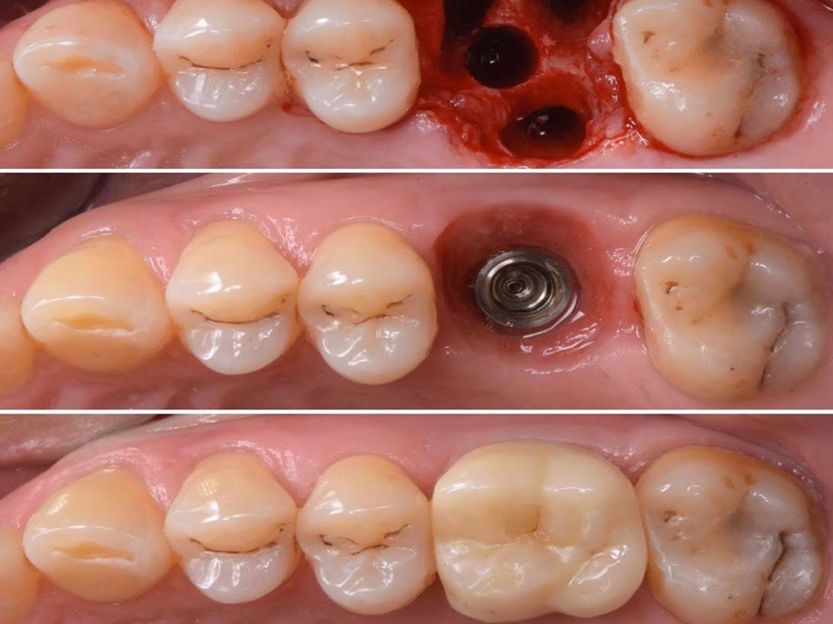Same Day Implants: Get Teeth In Hours Same Day Implants: Get Teeth In Hours