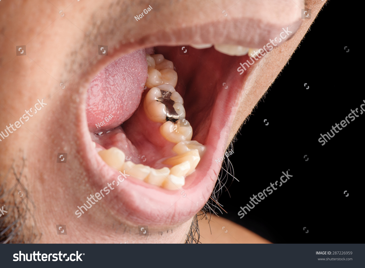 Silver Cavity Filling