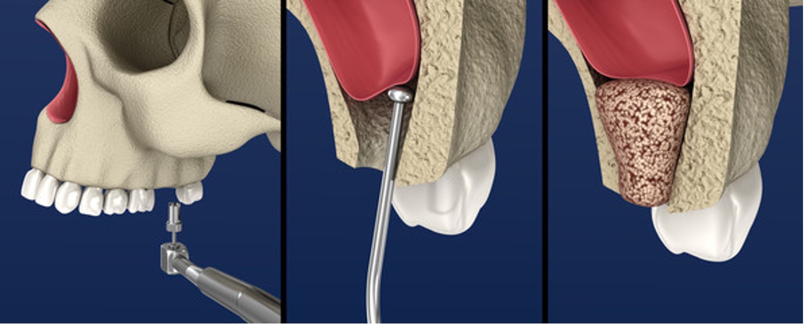 Sinus Augmentation Surgery: Boosts Dental Implant Success