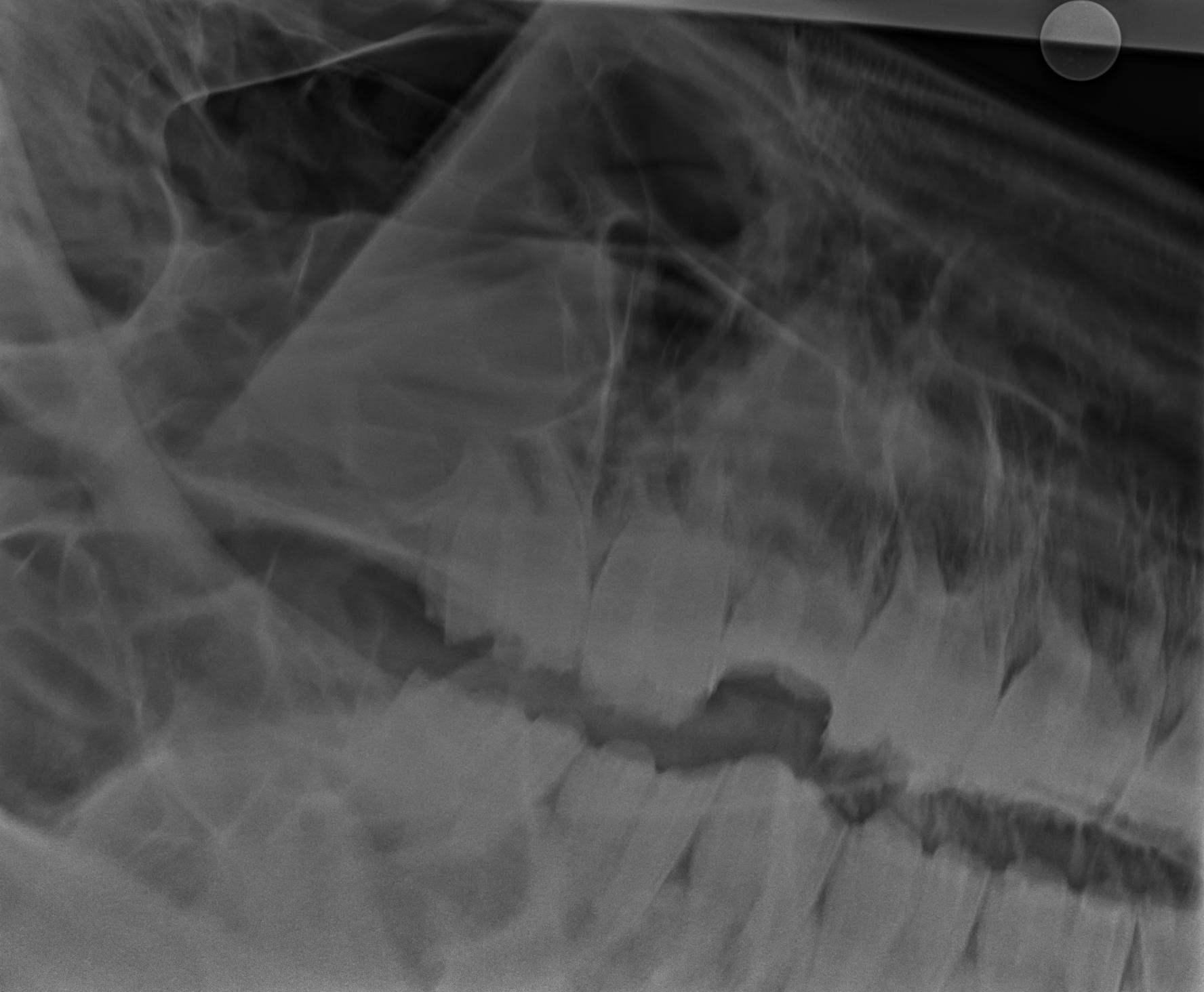 Sinus Infection Smelly Breath