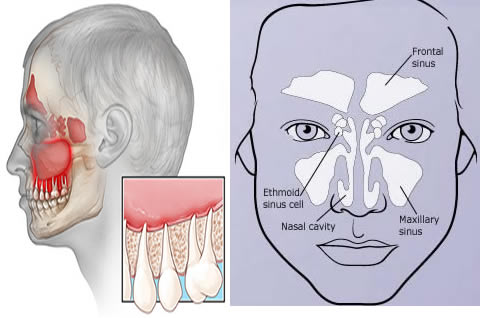 Sinus Toothache Remedy