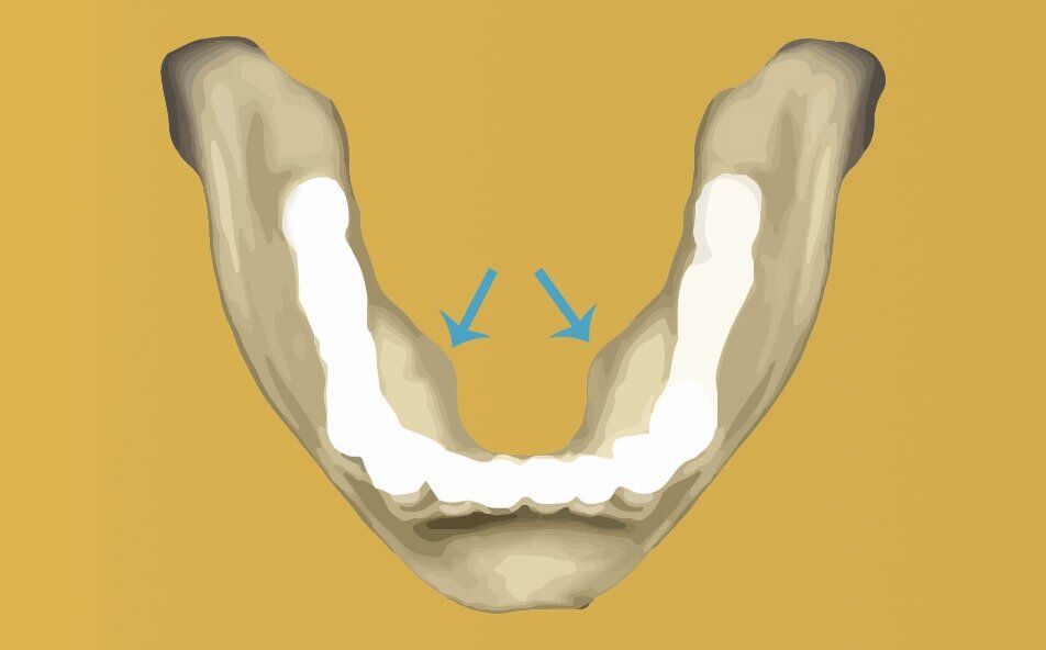 Small Mandibular Torus Removal Guide