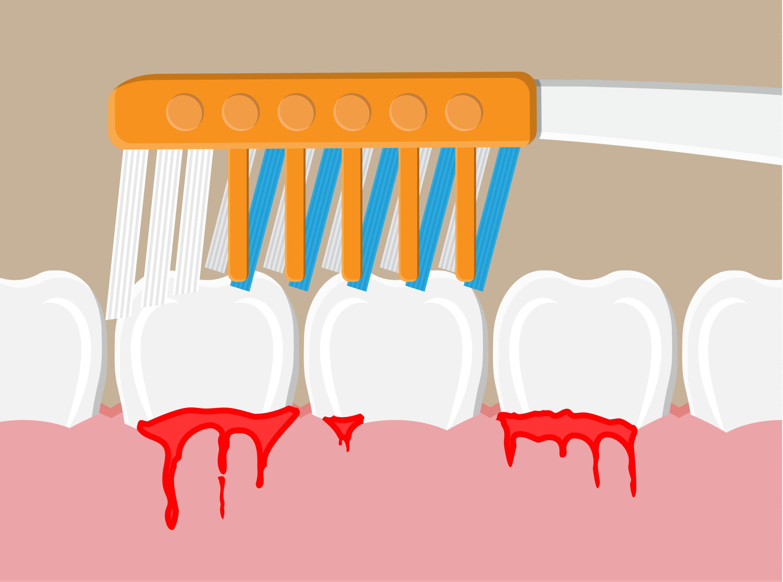 Soft Toothbrush For Bleeding Gums