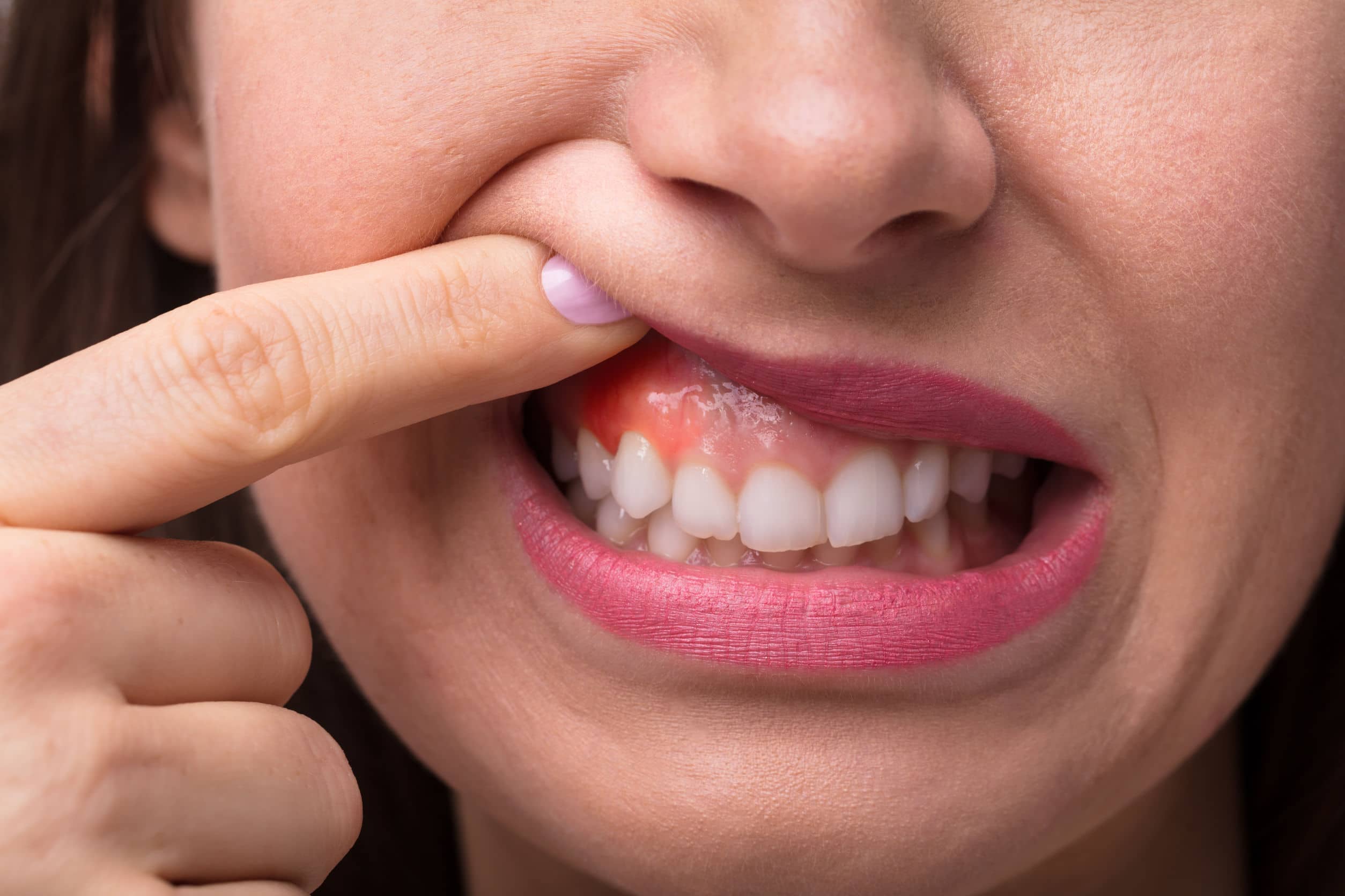 Sore Itchy Gums