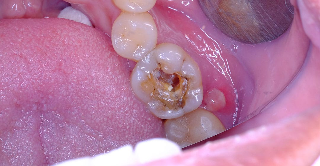 Split Tooth No Pain