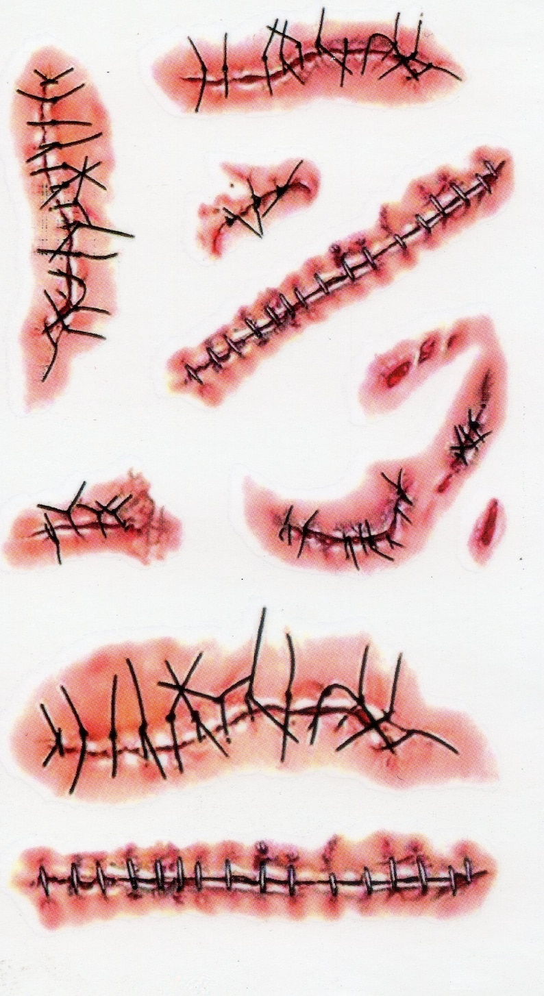 Stitches On Face Scar