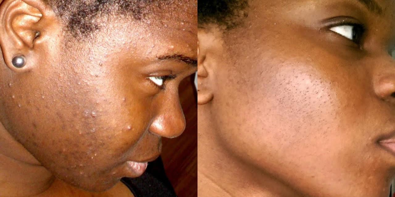 Tache Noir Sur Les Dents: Comment Les Retirer Facilement