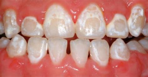 Teeth After Braces Stains