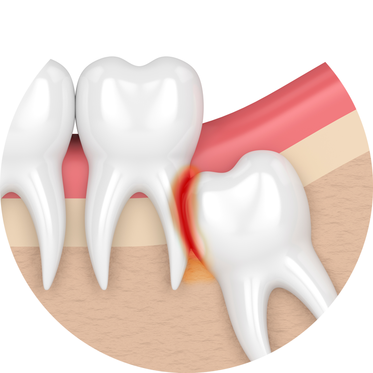 Teeth Becoming Transparent