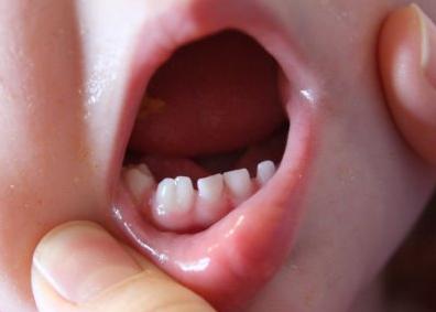 Teeth Fused Together