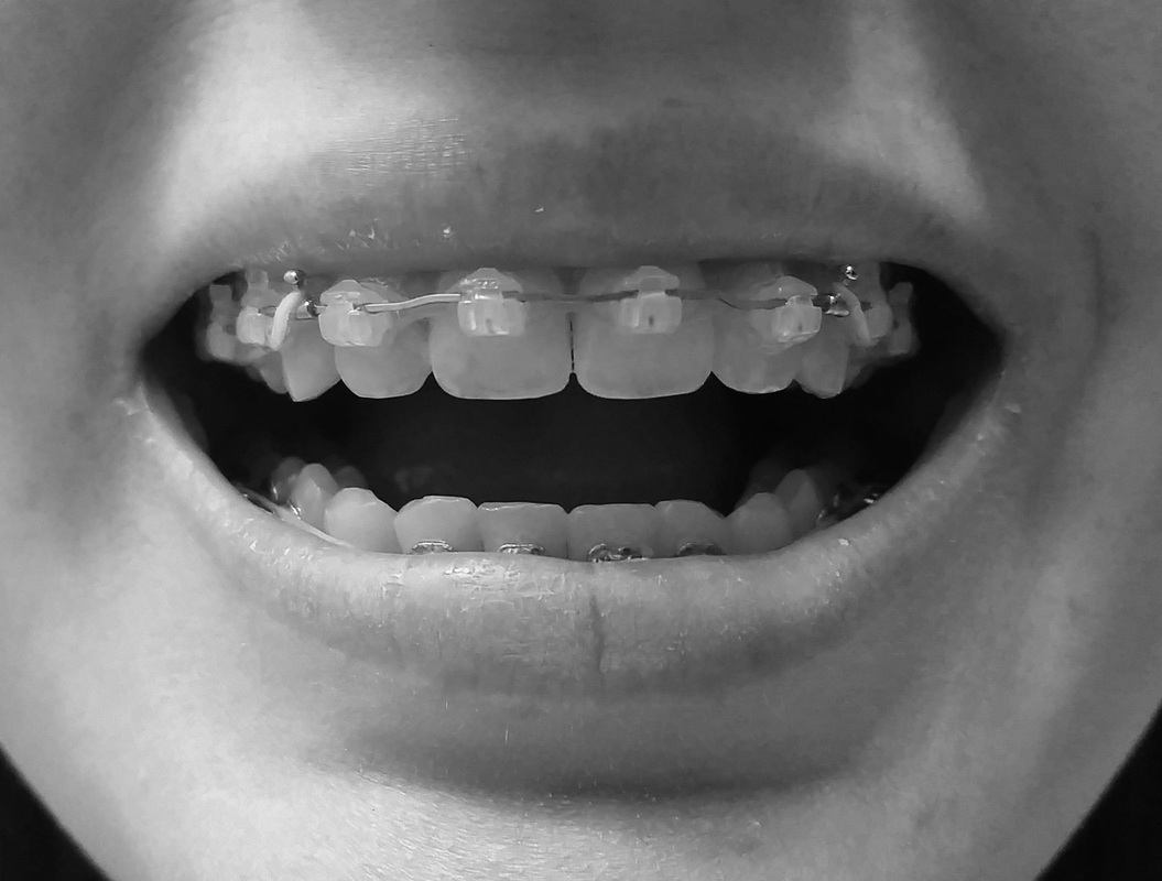 Teeth Reshaping Guide: Save Time And Money