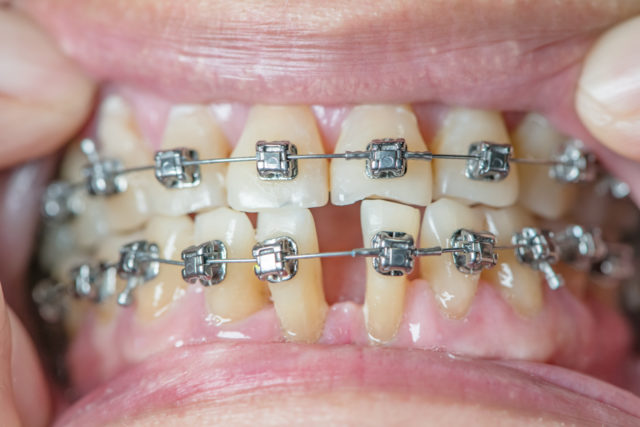 Teeth Stained From Braces Teeth Stained From Braces