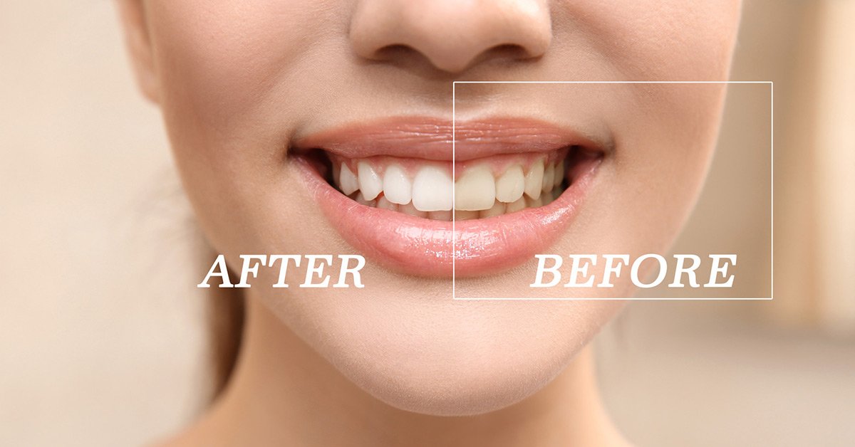 Teeth Turn Gray: Fix Discoloration Fast