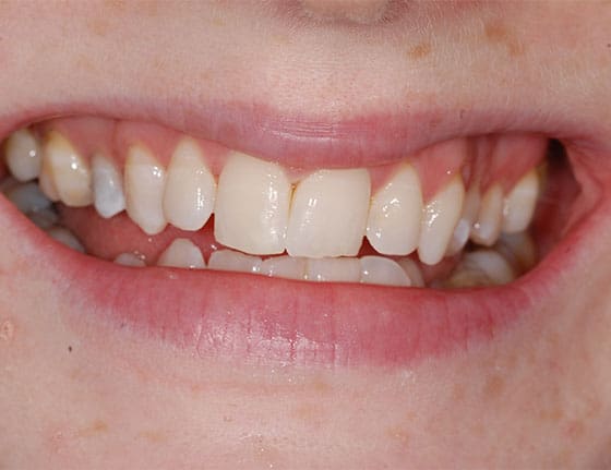 Teeth White Spot Removal
