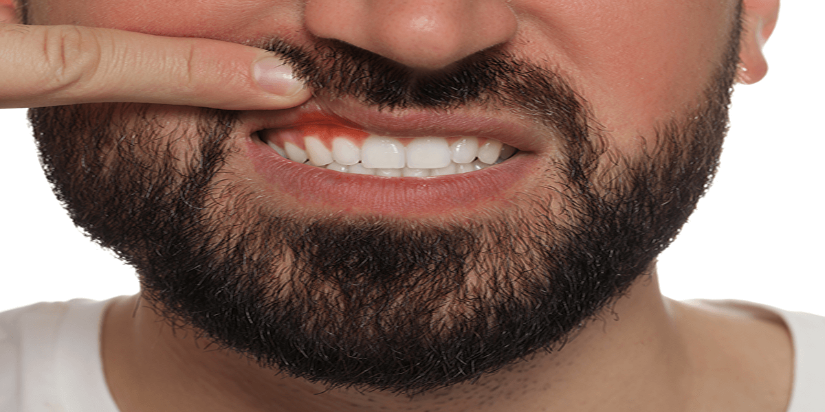 Teeth Whitening Gum Burn Relief Found
