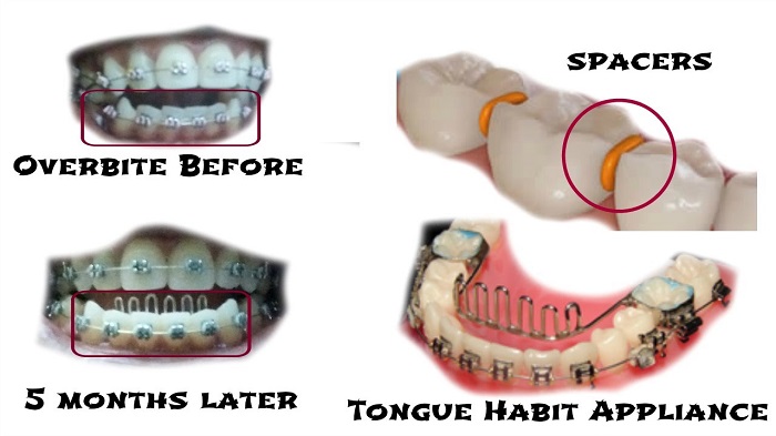 Teeth With Overbite
