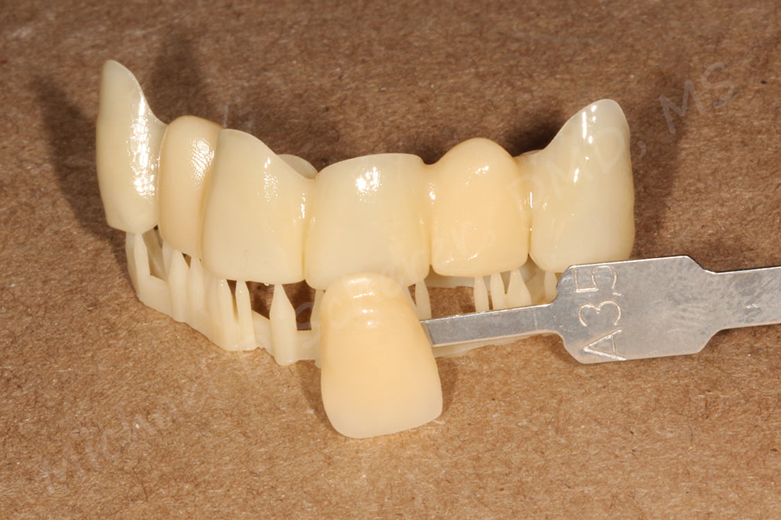 Temporary Dental Crown