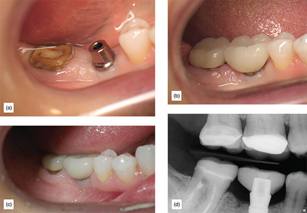 The Supragingival Protocol And Indications Preventing Subgingival The Supragingival Protocol And Indications Preventing Subgingival