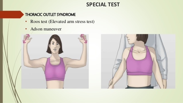 Thoracic Outlet Syndrome Exercise: Easy Relief Techniques