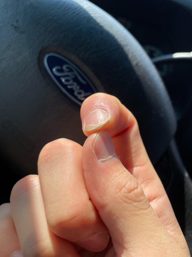 Toe Nail Growing Under Another