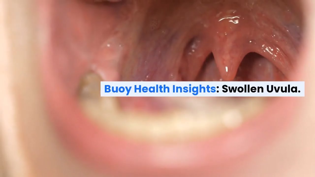 Tonsillectomy Uvula Swelling