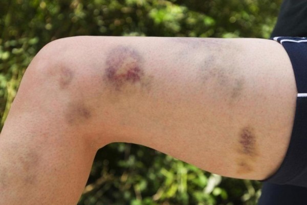 Tooth Bruise Solutions: Heal Faster Naturally