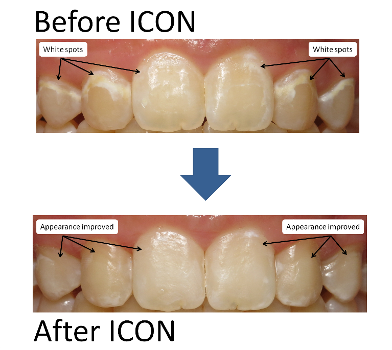 Tooth Has White Spot