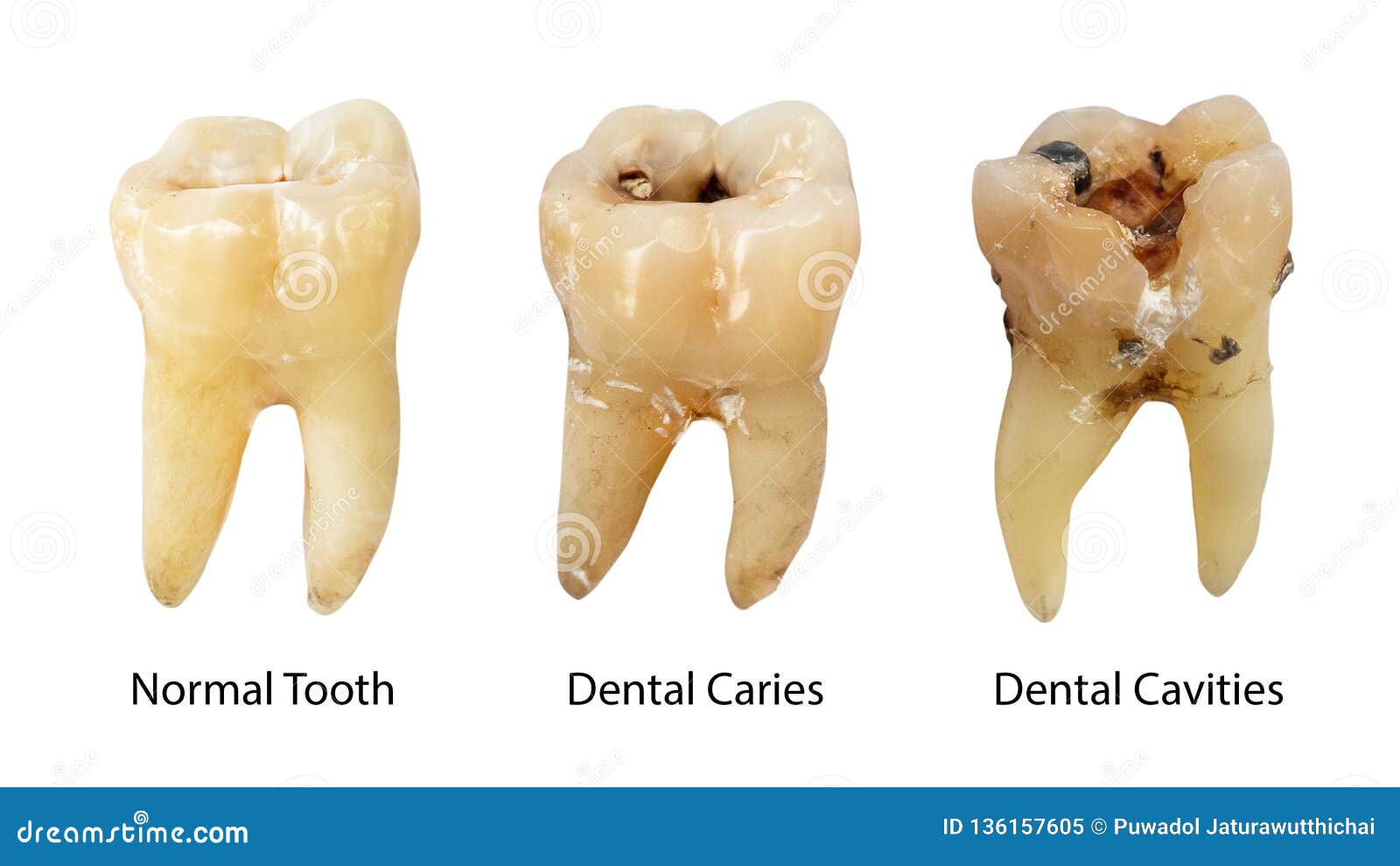 Tooth Hurts: Find Relief Without Cavities