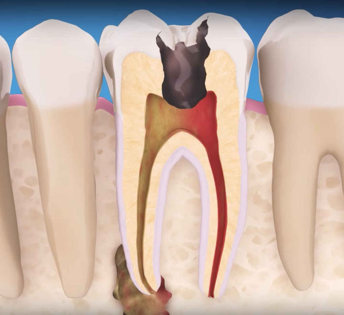Tooth Implant Or Root Canal