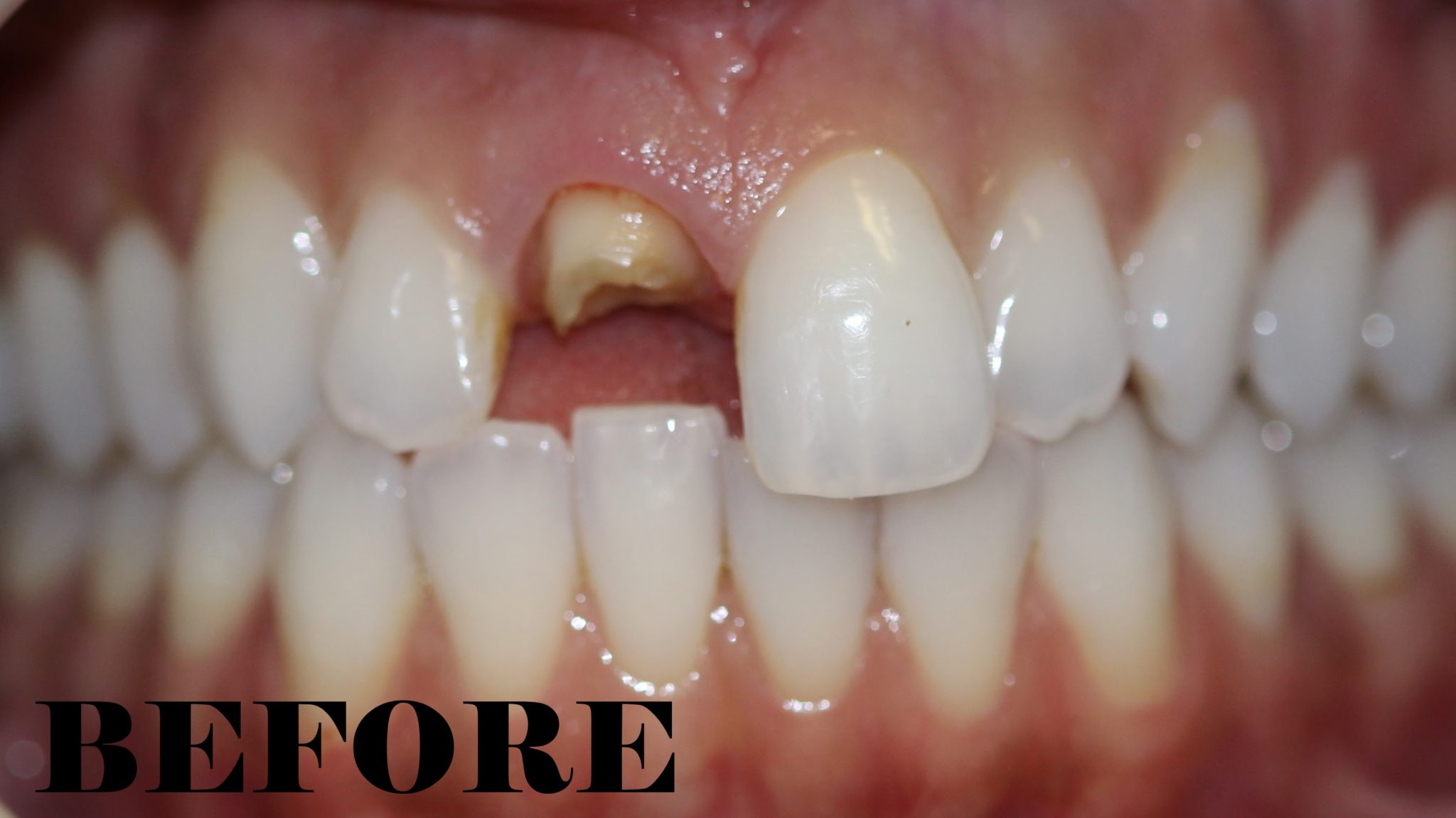 Tooth Repair Options: Fixing Broken Teeth