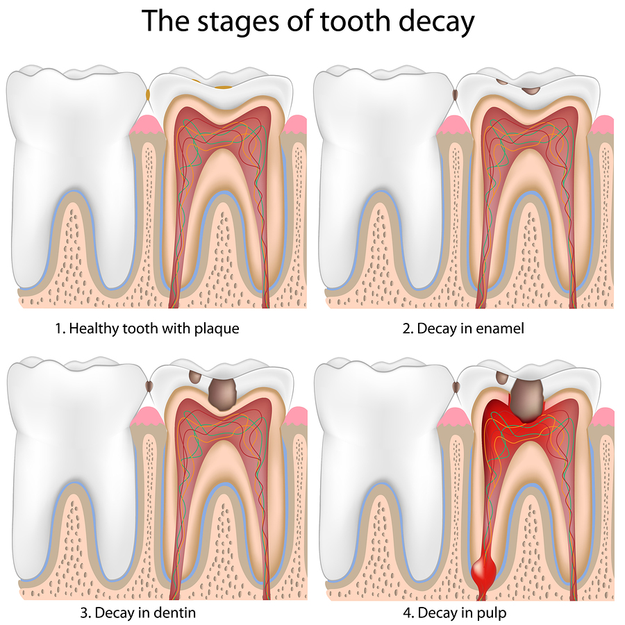 Toothache After Crown