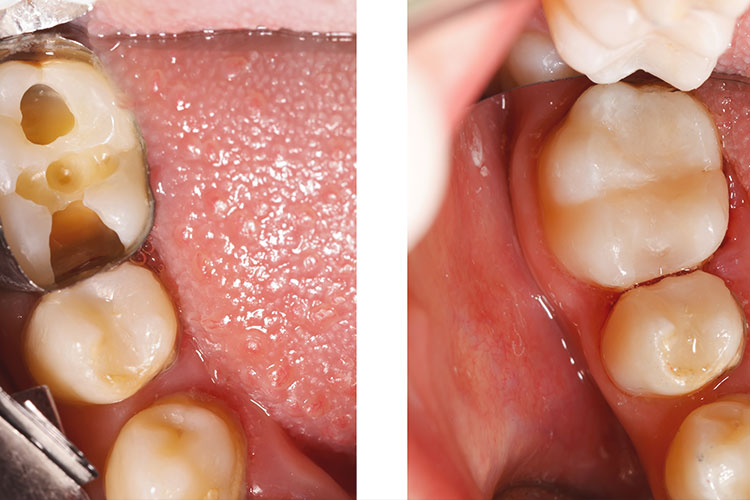 Toothcolored Fillings: Get Natural Smiles Quickly