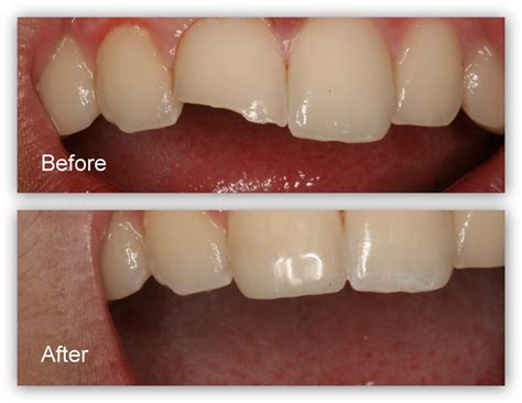 Toothcolored Fillings Near Me