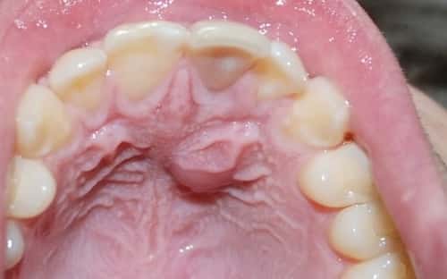 Top Mouth Hurts Top Mouth Hurts