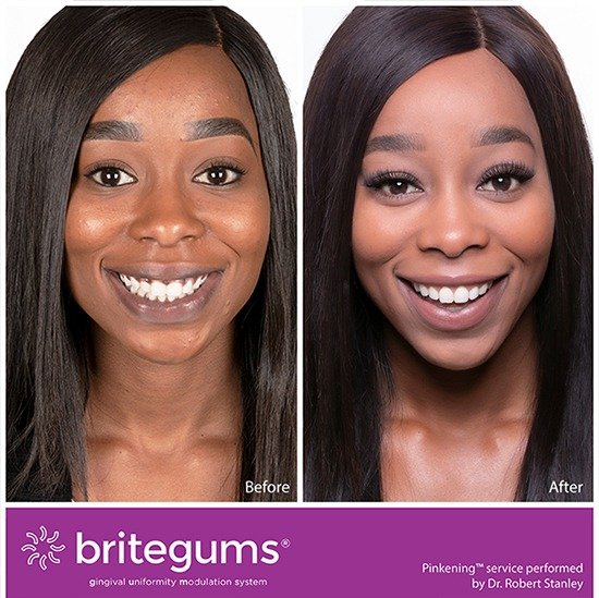 Treatment Of Black Gums