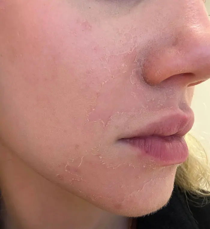 Tretinoin Peeling Around Mouth