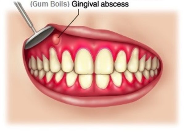 Understanding Your Bump On Gums Identifying Causes And Treatment Understanding Your Bump On Gums Identifying Causes And Treatment