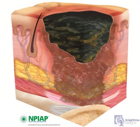 Unstageable Pressure Sore